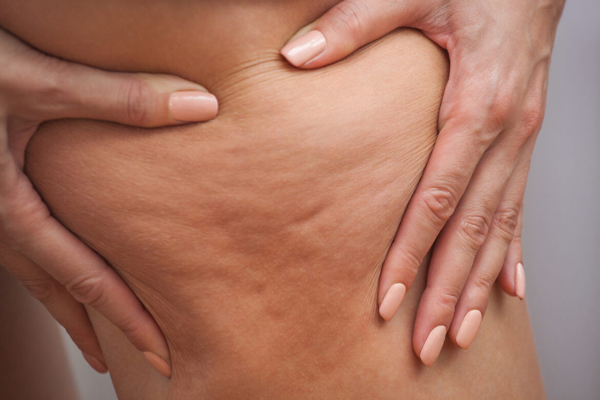 Best Cosmetic Procedures for Removing Cellulite